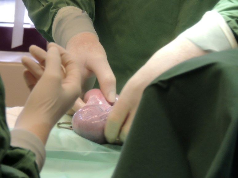 Bevalling 2015-07-15, 32